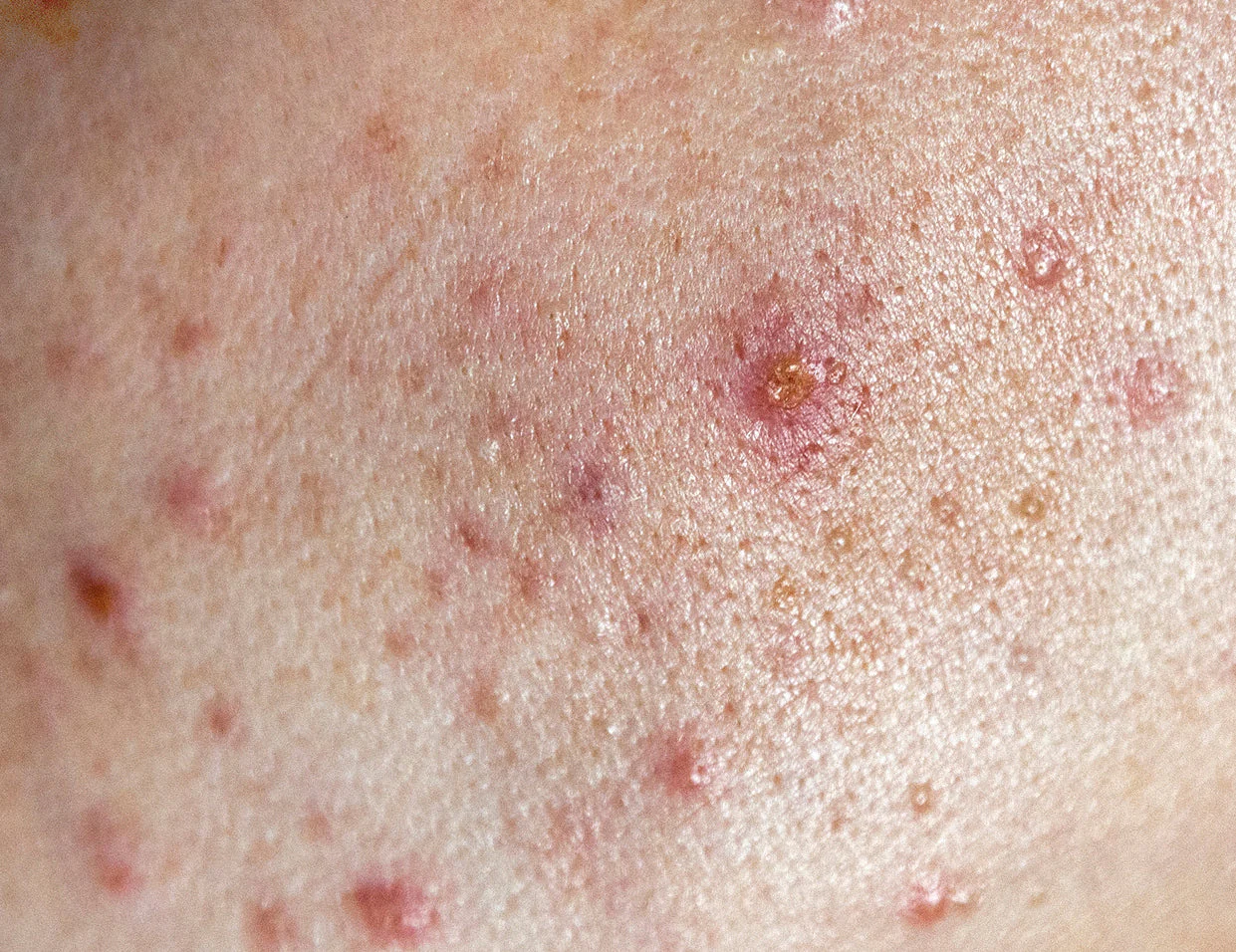 Skin Microbiome & Acne