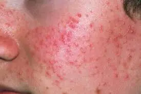 Breakouts