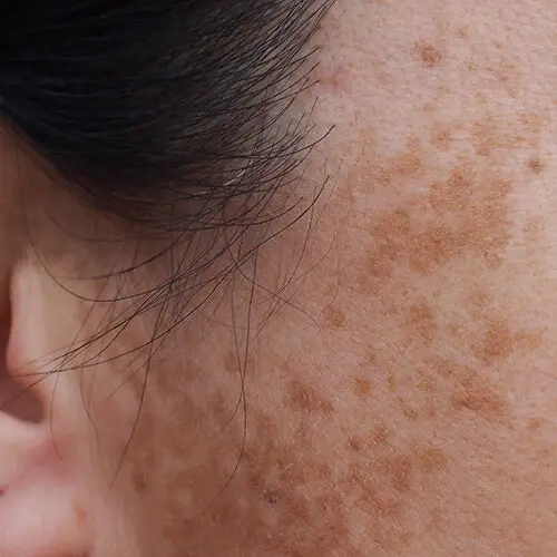Dark Spots