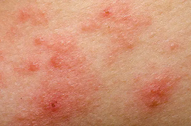 Skin Microbiome & Eczema
