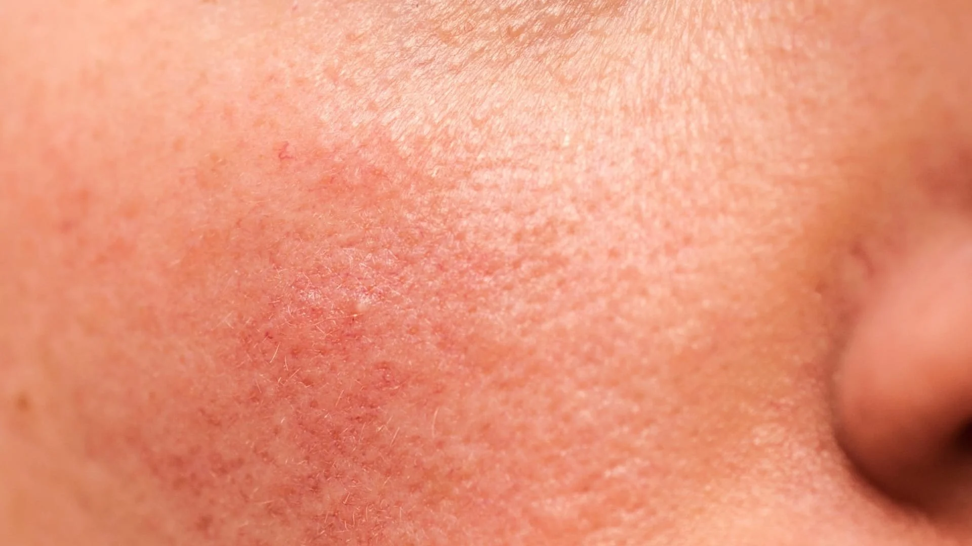 Skin Microbiome & Rosacea