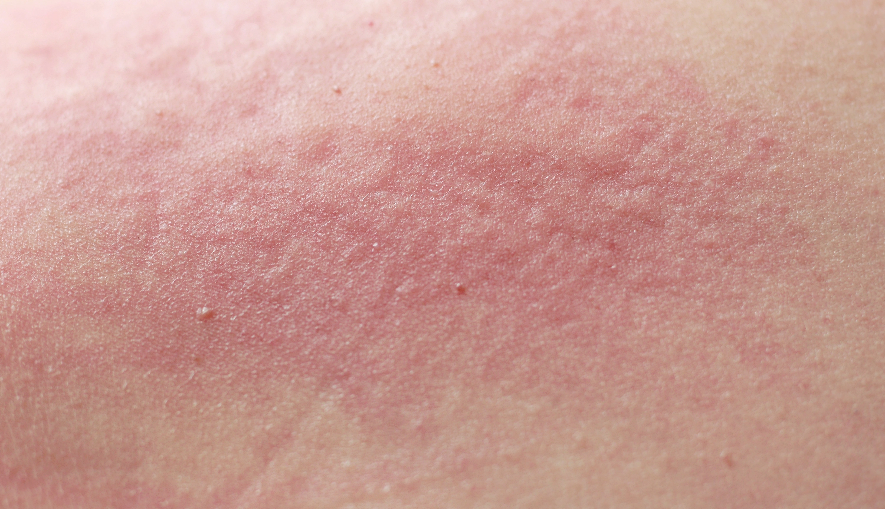 Microbiome & Sensitive Skin